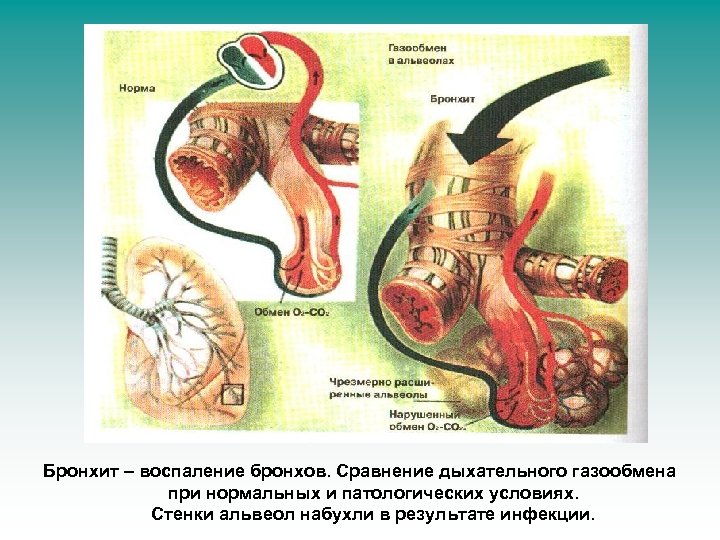 Бронхит – воспаление бронхов. Сравнение дыхательного газообмена при нормальных и патологических условиях. Стенки альвеол