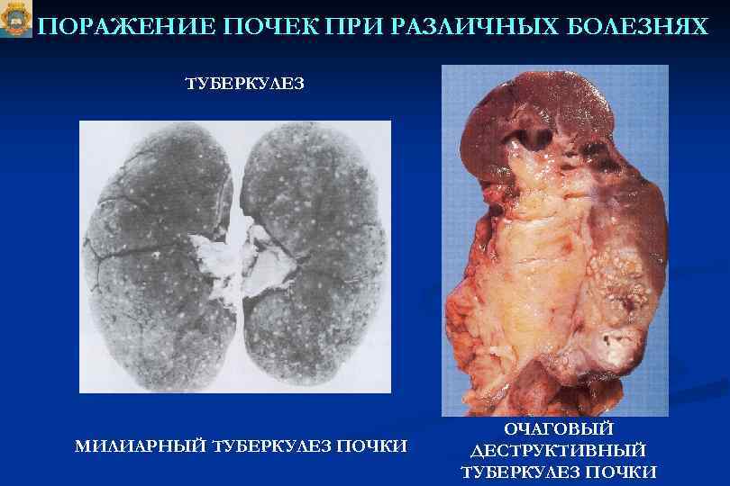 ПОРАЖЕНИЕ ПОЧЕК ПРИ РАЗЛИЧНЫХ БОЛЕЗНЯХ ТУБЕРКУЛЕЗ МИЛИАРНЫЙ ТУБЕРКУЛЕЗ ПОЧКИ ОЧАГОВЫЙ ДЕСТРУКТИВНЫЙ ТУБЕРКУЛЕЗ ПОЧКИ 