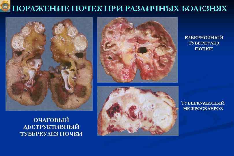 ПОРАЖЕНИЕ ПОЧЕК ПРИ РАЗЛИЧНЫХ БОЛЕЗНЯХ КАВЕРНОЗНЫЙ ТУБЕРКУЛЕЗ ПОЧКИ ТУБЕРКУЛЕЗНЫЙ НЕФРОСКЛЕРОЗ ОЧАГОВЫЙ ДЕСТРУКТИВНЫЙ ТУБЕРКУЛЕЗ ПОЧКИ