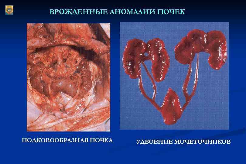 ВРОЖДЕННЫЕ АНОМАЛИИ ПОЧЕК ПОДКОВООБРАЗНАЯ ПОЧКА УДВОЕНИЕ МОЧЕТОЧНИКОВ 