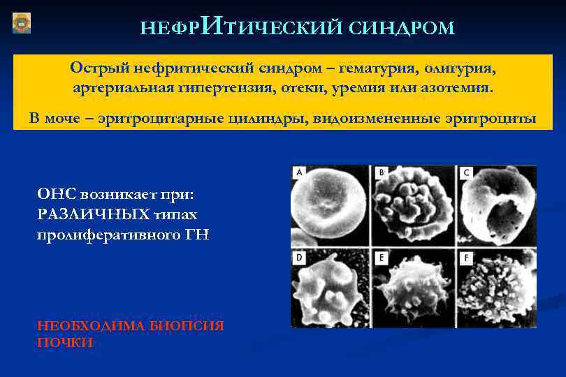 НЕФРИТИЧЕСКИЙ СИНДРОМ Острый нефритический синдром – гематурия, олигурия, артериальная гипертензия, отеки, уремия или азотемия.