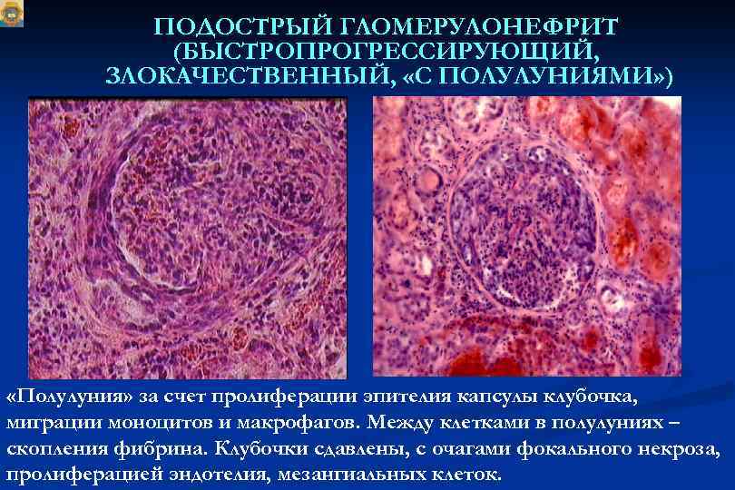 ПОДОСТРЫЙ ГЛОМЕРУЛОНЕФРИТ (БЫСТРОПРОГРЕССИРУЮЩИЙ, ЗЛОКАЧЕСТВЕННЫЙ, «С ПОЛУЛУНИЯМИ» ) «Полулуния» за счет пролиферации эпителия капсулы клубочка,