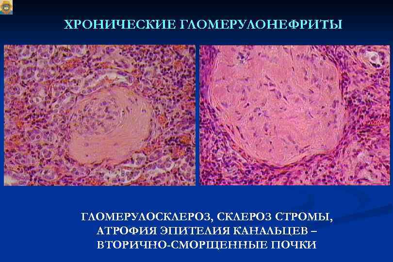 ХРОНИЧЕСКИЕ ГЛОМЕРУЛОНЕФРИТЫ ГЛОМЕРУЛОСКЛЕРОЗ, СКЛЕРОЗ СТРОМЫ, АТРОФИЯ ЭПИТЕЛИЯ КАНАЛЬЦЕВ – ВТОРИЧНО-СМОРЩЕННЫЕ ПОЧКИ 