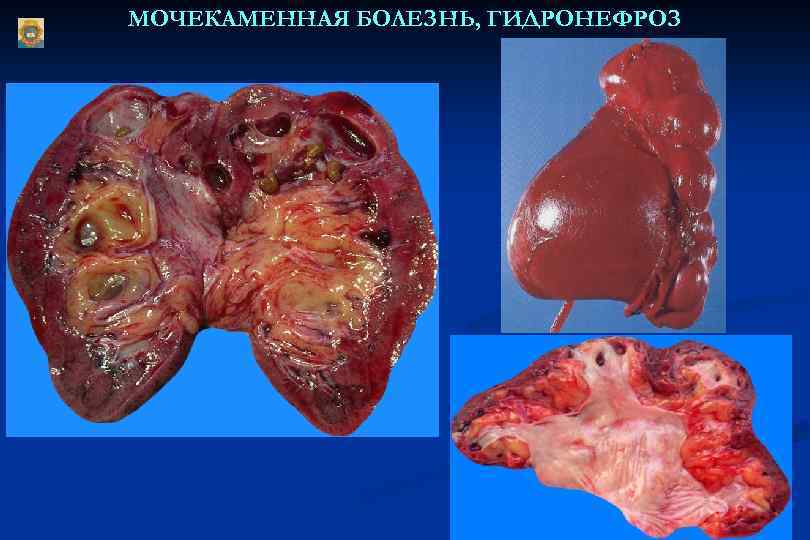 МОЧЕКАМЕННАЯ БОЛЕЗНЬ, ГИДРОНЕФРОЗ 