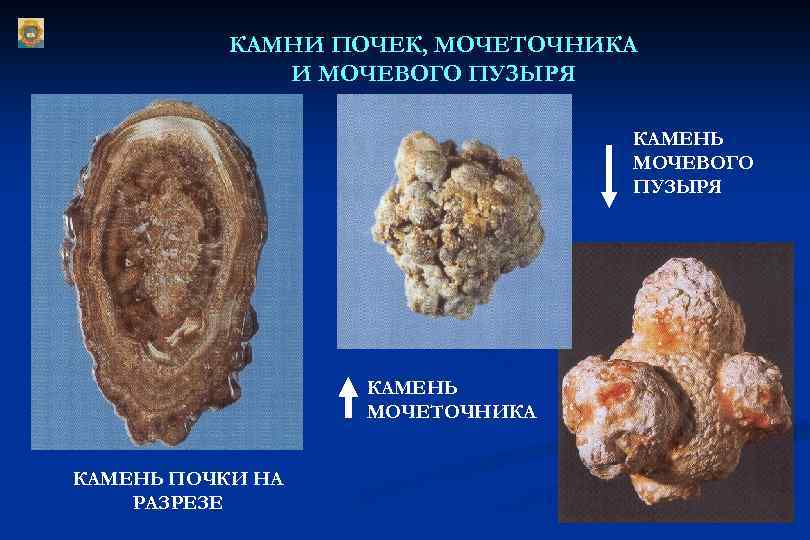 КАМНИ ПОЧЕК, МОЧЕТОЧНИКА И МОЧЕВОГО ПУЗЫРЯ КАМЕНЬ МОЧЕТОЧНИКА КАМЕНЬ ПОЧКИ НА РАЗРЕЗЕ 