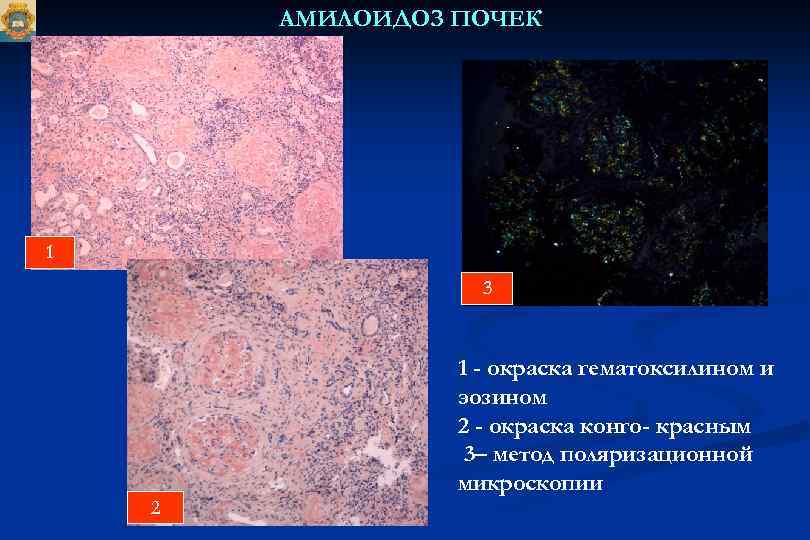 АМИЛОИДОЗ ПОЧЕК 1 3 1 - окраска гематоксилином и эозином 2 - окраска конго-
