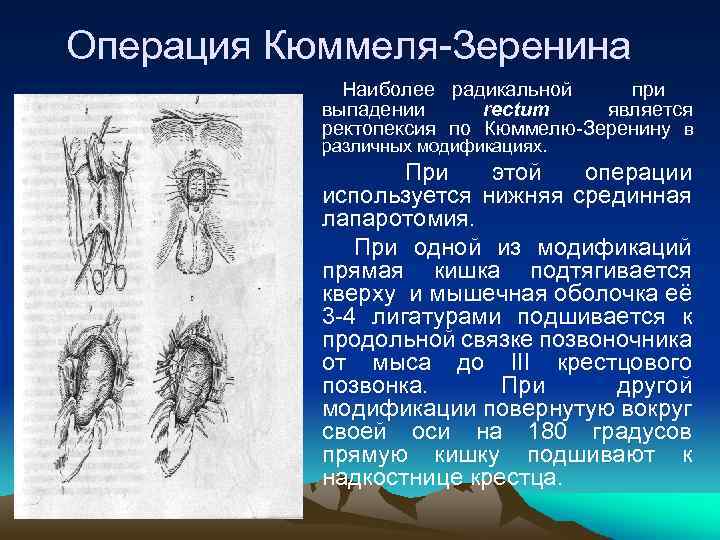 Выпадение кишки. Операция Зеренина-Кюммеля-Герцена. Операции при выпадении прямой кишки ректопексия. Ректопексия по Кюммелю-Зеренину.