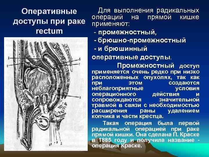 Презентация операции на прямой кишке