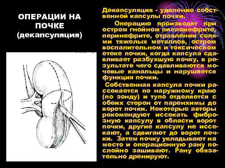 ОПЕРАЦИИ НА ПОЧКЕ (декапсуляция) Декапсуляция - удаление собственной капсулы почки. Операцию производят при остром