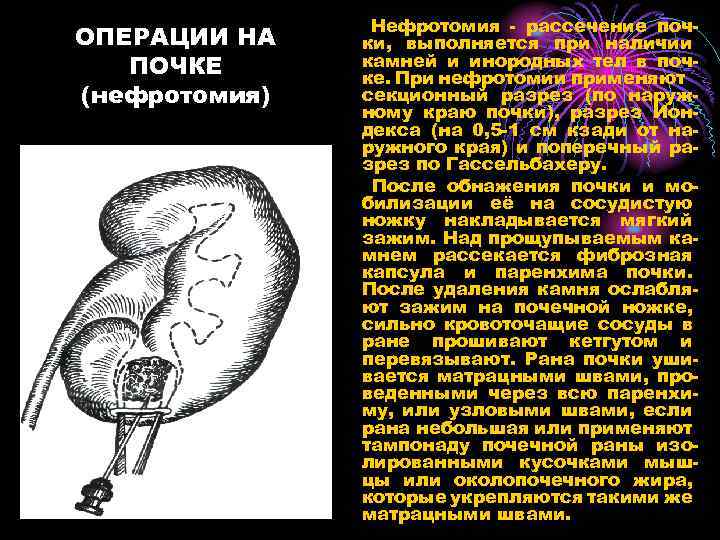 ОПЕРАЦИИ НА ПОЧКЕ (нефротомия) Нефротомия - рассечение почки, выполняется при наличии камней и инородных