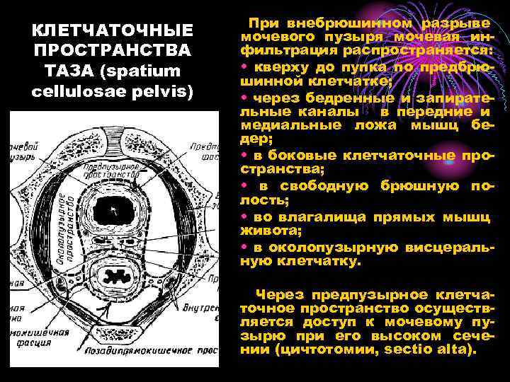 КЛЕТЧАТОЧНЫЕ ПРОСТРАНСТВА ТАЗА (spatium cellulosae pelvis) При внебрюшинном разрыве мочевого пузыря мочевая инфильтрация распространяется: