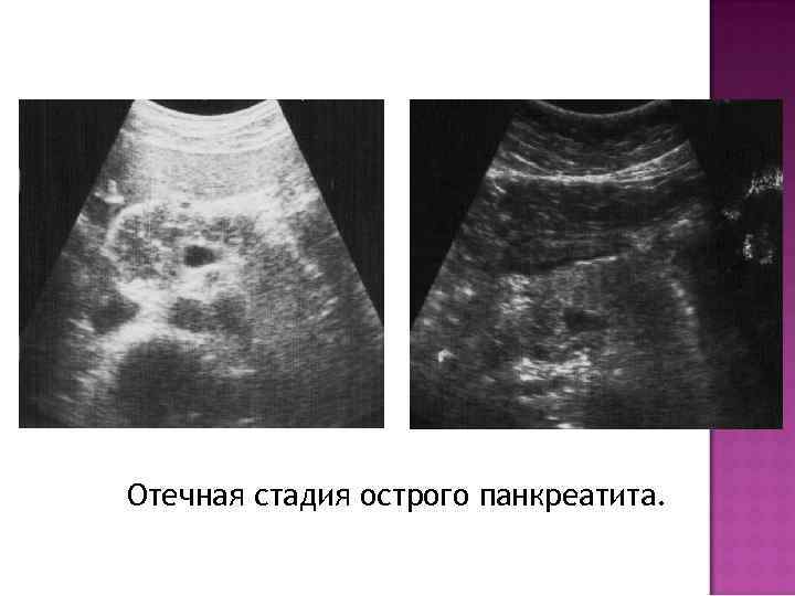 Отечная стадия острого панкреатита. 