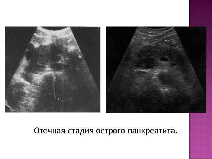 Отечная стадия острого панкреатита. 