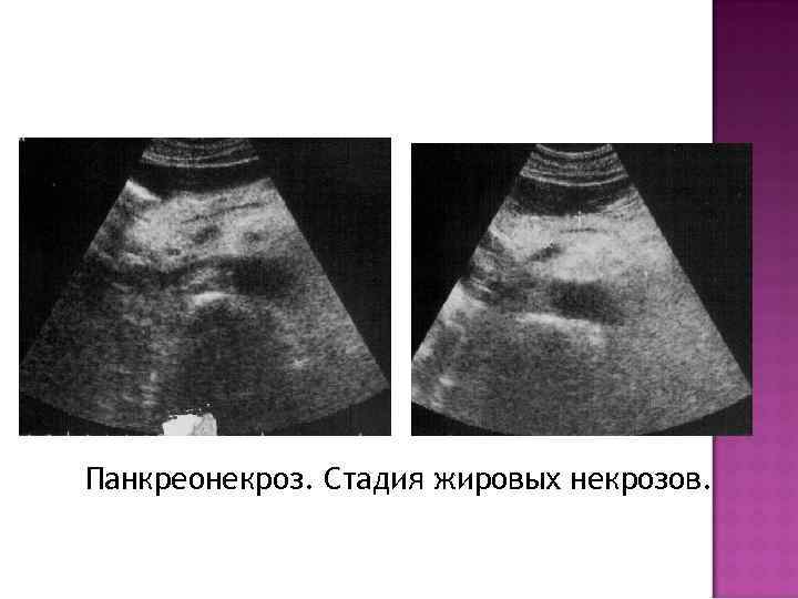Панкреонекроз. Стадия жировых некрозов. 