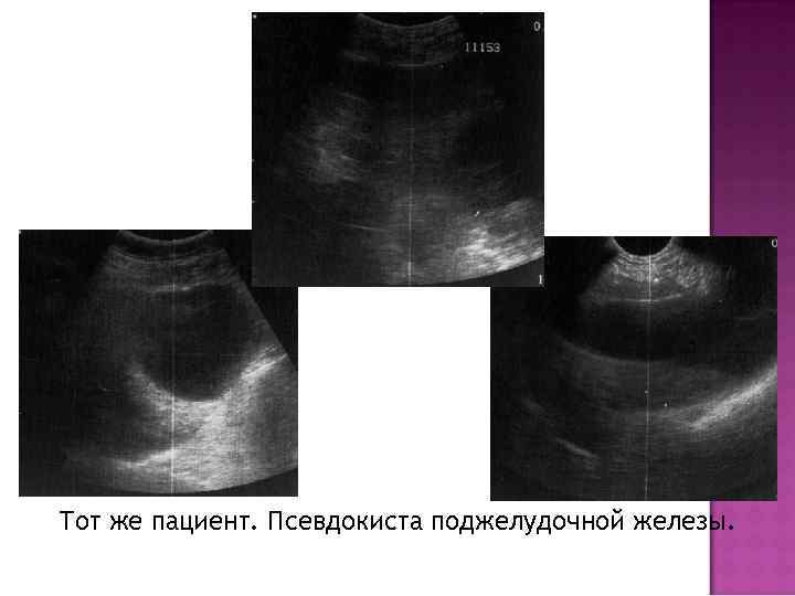 Тот же пациент. Псевдокиста поджелудочной железы. 