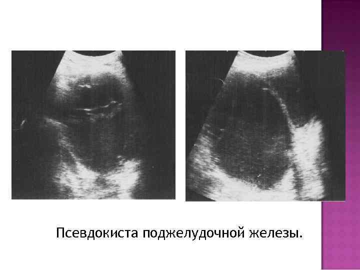 Псевдокиста поджелудочной железы. 