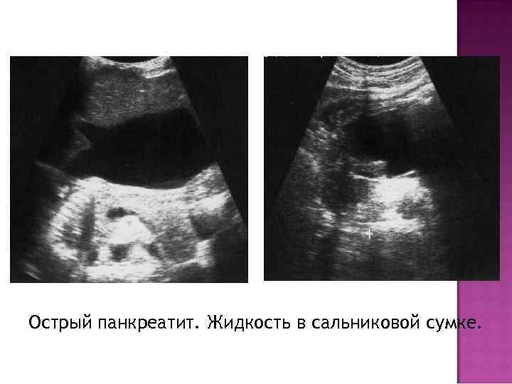 Острый панкреатит. Жидкость в сальниковой сумке. 
