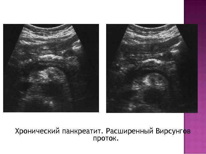 Узи картина хронического панкреатита