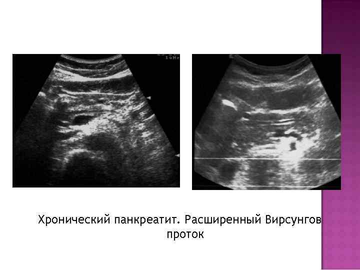 Хронический панкреатит. Расширенный Вирсунгов проток 