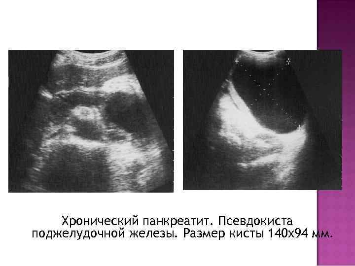 Хронический панкреатит. Псевдокиста поджелудочной железы. Размер кисты 140 х94 мм. 