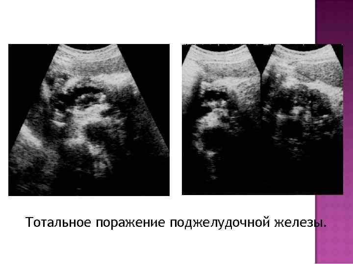 Тотальное поражение поджелудочной железы. 