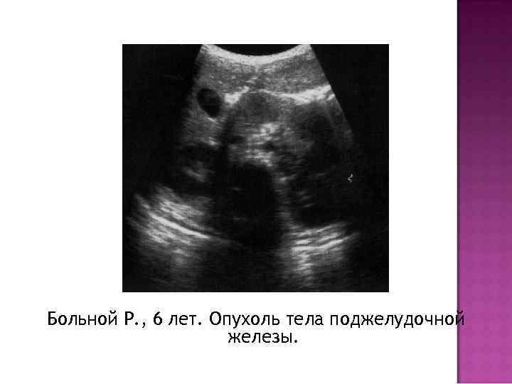 Больной Р. , 6 лет. Опухоль тела поджелудочной железы. 