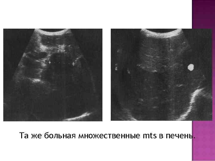 Та же больная множественные mts в печень. 