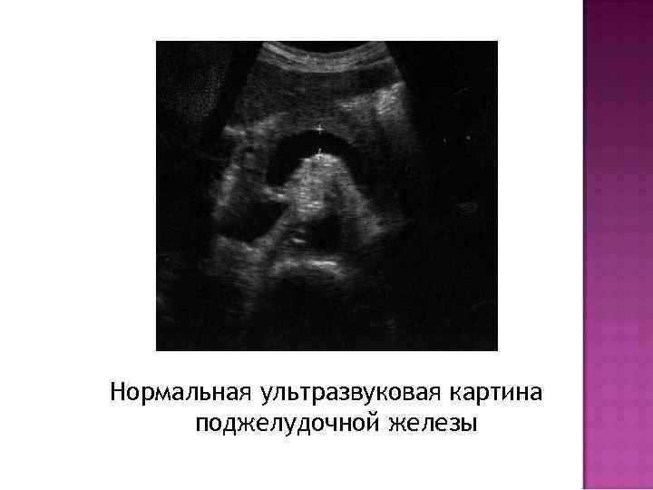 Нормальная ультразвуковая картина поджелудочной железы 