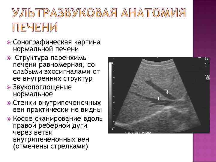 Сонографическая картина нормальной печени Структура паренхимы печени равномерная, со слабыми эхосигналами от ее внутренних