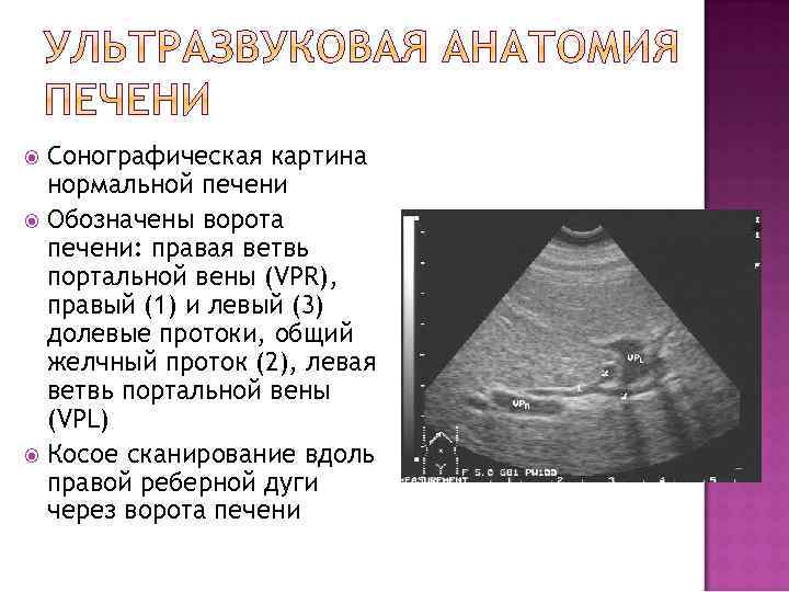 Сонографическая картина нормальной печени Обозначены ворота печени: правая ветвь портальной вены (VPR), правый (1)