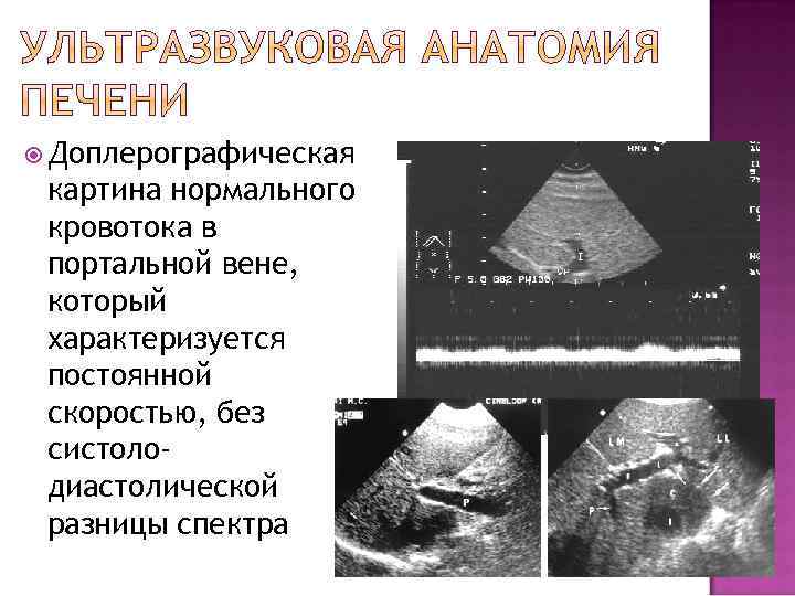  Доплерографическая картина нормального кровотока в портальной вене, который характеризуется постоянной скоростью, без систолодиастолической