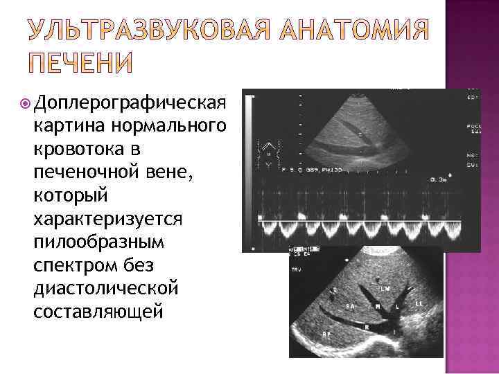  Доплерографическая картина нормального кровотока в печеночной вене, который характеризуется пилообразным спектром без диастолической