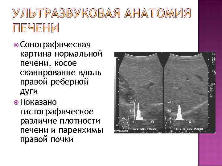  Сонографическая картина нормальной печени, косое сканирование вдоль правой реберной дуги Показано гистографическое различие