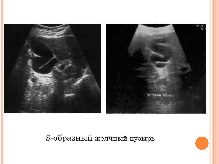 S-образный желчный пузырь 