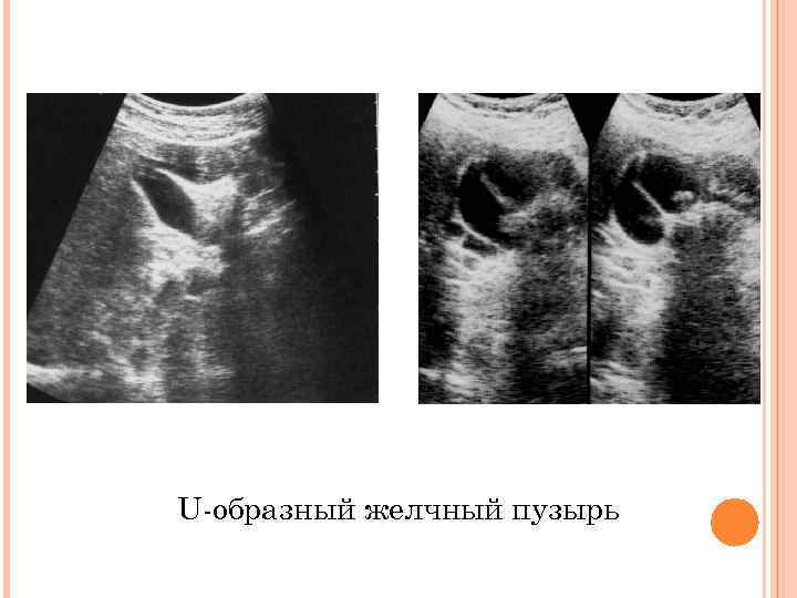 U-образный желчный пузырь 