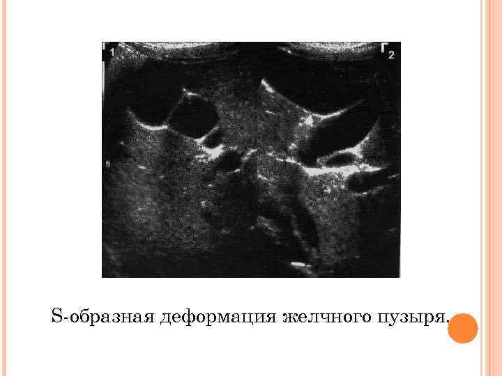 Желчный деформирован перегибом