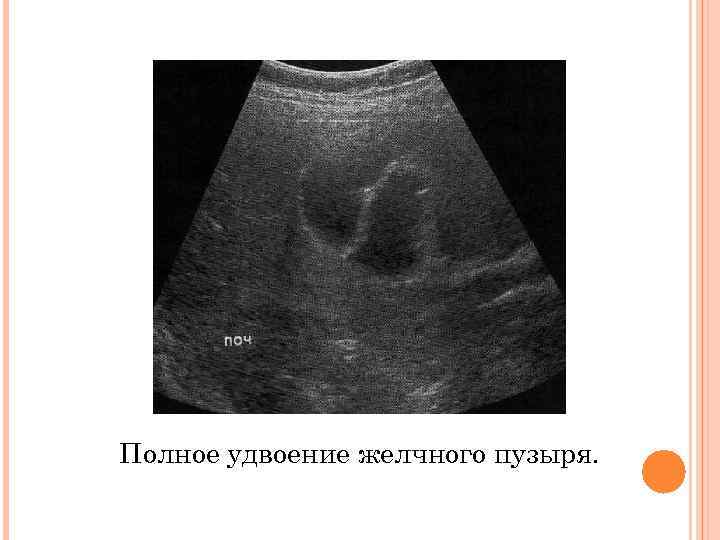 Полное удвоение желчного пузыря. 