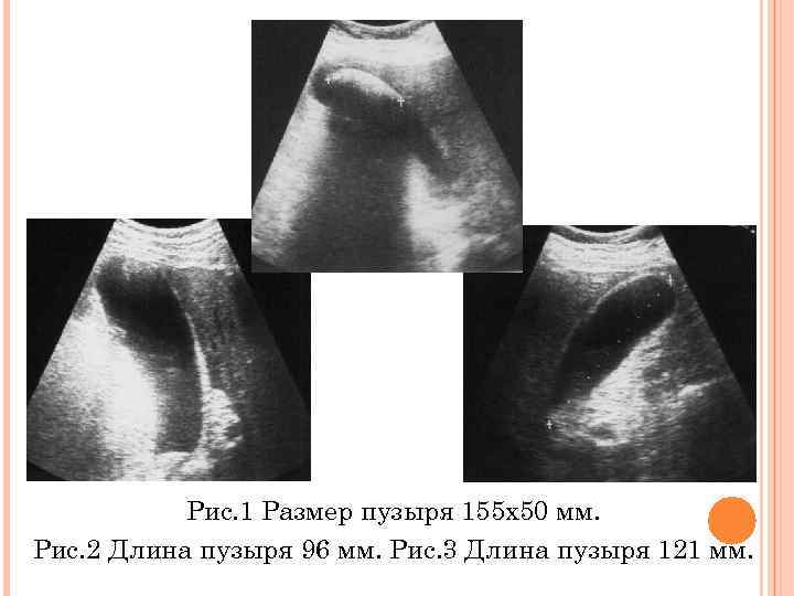 Рис. 1 Размер пузыря 155 х50 мм. Рис. 2 Длина пузыря 96 мм. Рис.