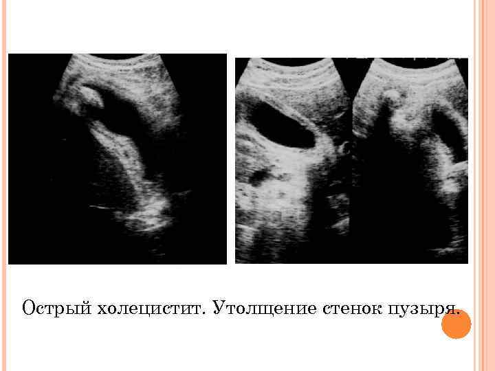 Острый холецистит. Утолщение стенок пузыря. 