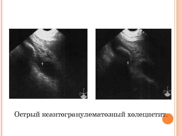 Острый ксантогранулематозный холецистит. 