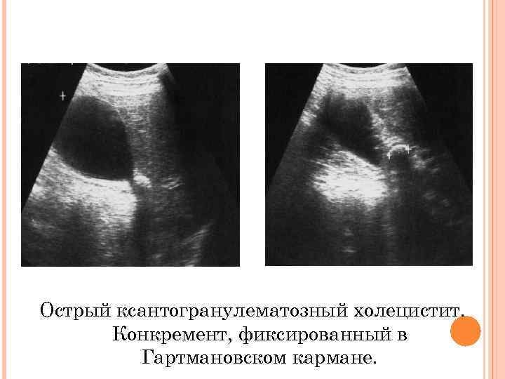 Острый ксантогранулематозный холецистит. Конкремент, фиксированный в Гартмановском кармане. 