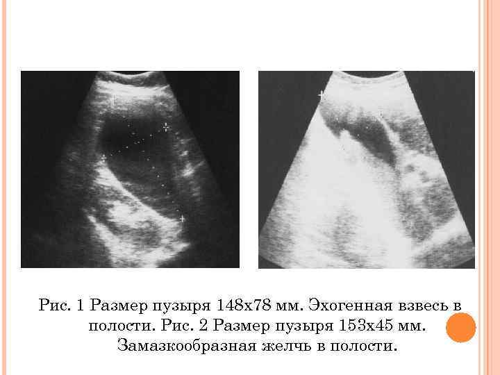 Рис. 1 Размер пузыря 148 х78 мм. Эхогенная взвесь в полости. Рис. 2 Размер