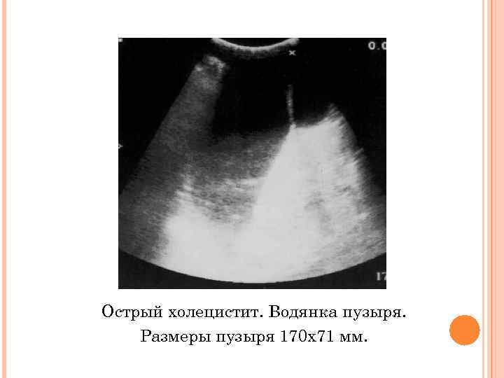 Острый холецистит. Водянка пузыря. Размеры пузыря 170 х71 мм. 
