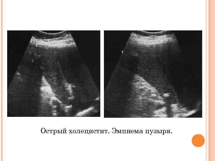 Острый холецистит. Эмпиема пузыря. 