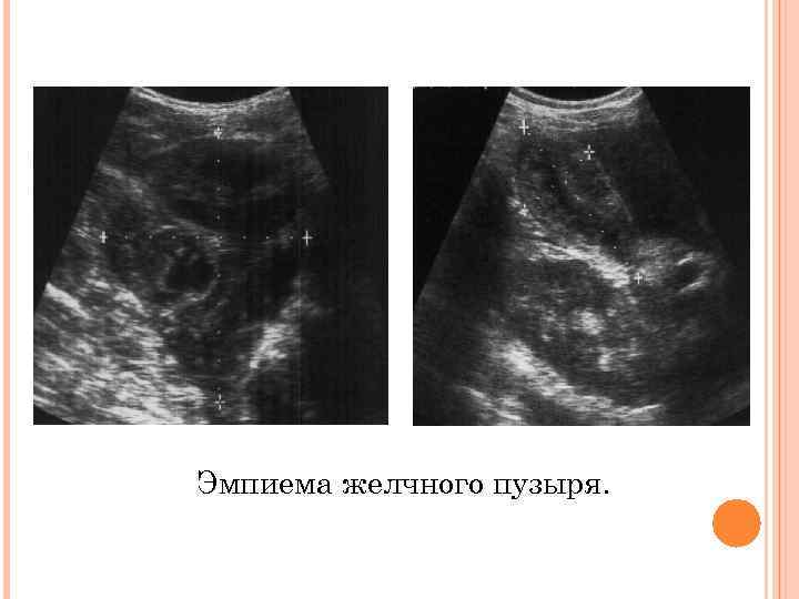 Эмпиема желчного пузыря. 