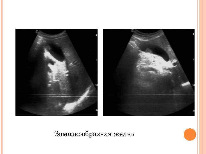 Замазкообразная желчь 