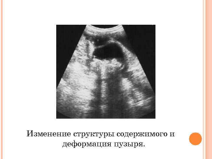 Изменение структуры содержимого и деформация пузыря. 