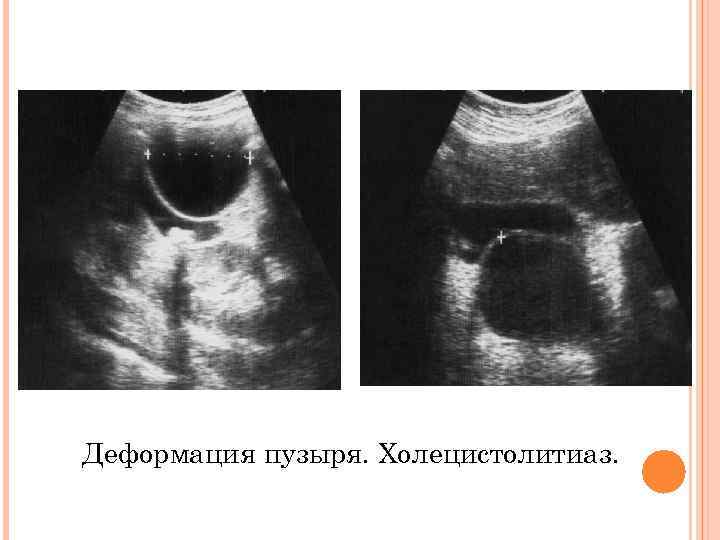Деформация пузыря. Холецистолитиаз. 
