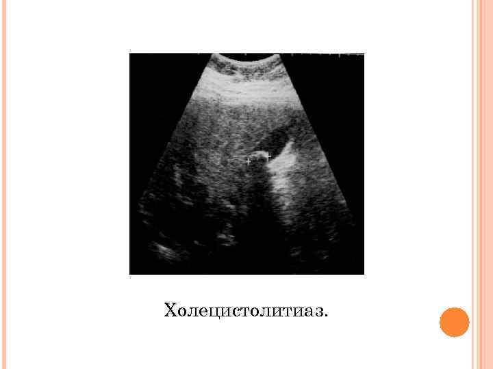 Холецистолитиаз. 