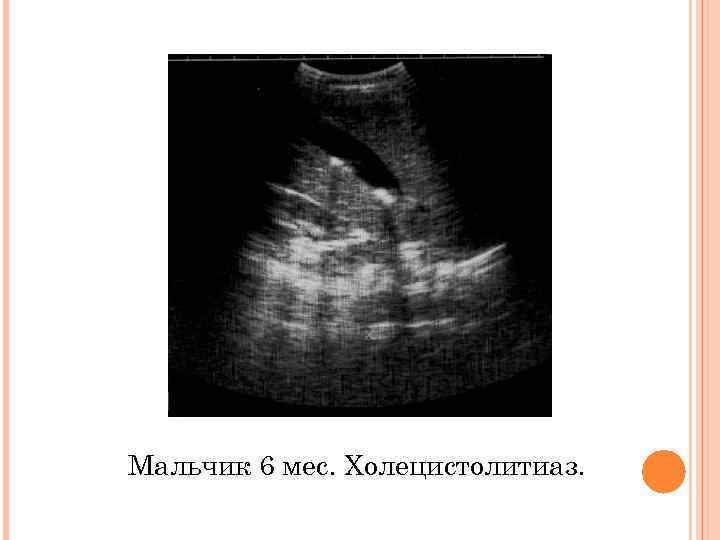 Мальчик 6 мес. Холецистолитиаз. 